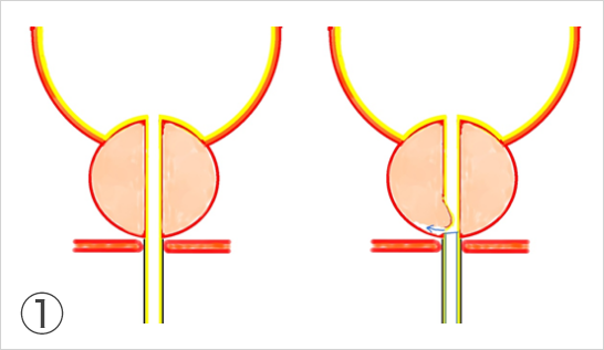 尿道粘膜をレーザーで切開し、前立腺の内腺と外腺の境界を見つけ、その間に内視鏡を入れます。