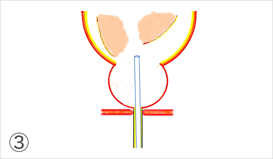 左右、中葉（図では略していますが、普通内腺は中葉も合わせて2～3つに分かれています）の内腺を全て膀胱の中に摘出します。
