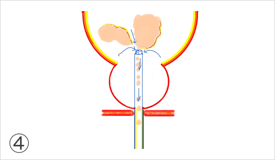 レーザーから、専用の器械に入れ換え、膀胱内の前立腺内腺を吸引しながら細かく砕いて体外に排出します。