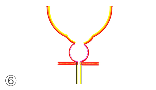 術翌日カテーテル抜去後、前立腺内腺がなくなり、前立腺被膜（外腺）は収縮し、膀胱の出口はひょうたんを逆さまにしたような形状になります。