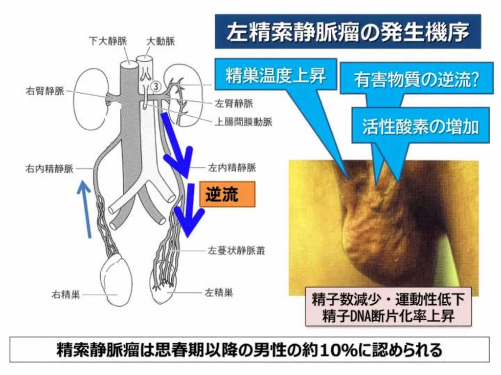 精索静脈瘤の発生機序