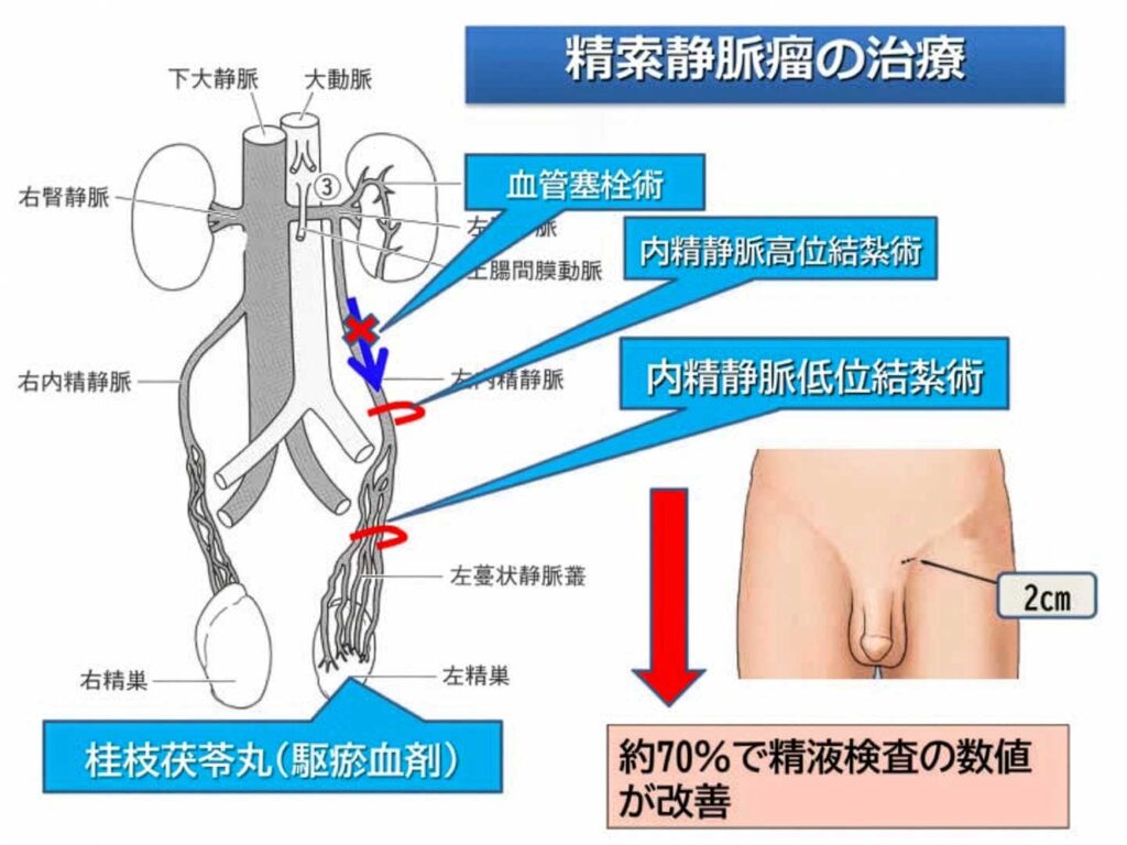精索静脈瘤の治療